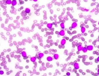 L&rsquo;An&eacute;mie de Fanconi