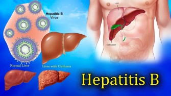Etude sur lhépatite B : 300 millions de malades dont 95% pas ou mal traités