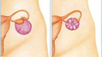 Un test multimarqueurs pour le dépistage du cancer de l’ovaire