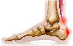 Tendinite du tendon d’Achille