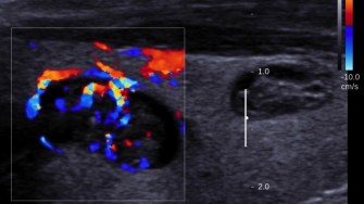 Intérêt de la recherche du ganglion sentinelle dans les tumeurs folliculaires de la thyroïde