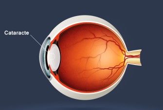 Cataracte:  symptômes silencieux à reconnaître