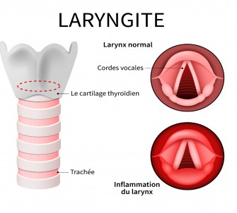Laryngite
