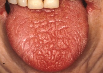 Le syndrome de Gougerot-Sjögren