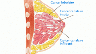 Le cancer du sein