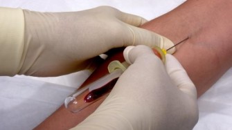Un test sanguin prometteur pour le diagnostic précoce  de cancers colorectaux