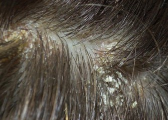 La dermatite séborrhéique de ladulte