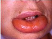 Œdème de  Quincke : gonflement très marqué des lèvres
