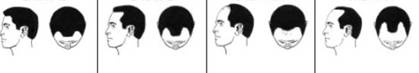 Divers stade de chute des cheveux chez l'homme