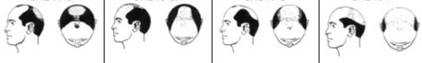 Divers stade de chute des cheveux chez l'homme