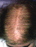 Chute de cheveux de type alopécie diffuse