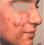Différentes formes d'acné