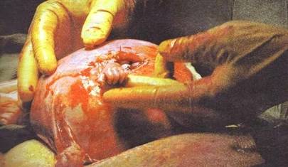 Pendant que le Dr. Bruner opérait, le bébé a sorti par l'incision. sa main minuscule, mais entièrement développée, et a Fermement saisi le doigt du chirurgien.