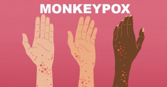 Monkeypox ( Variole du Singe)