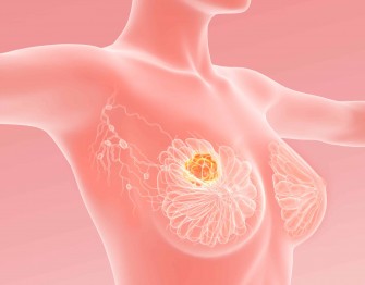 Cancer du sein : pourquoi certains cancers r&eacute;sistent-ils aux traitements ? Les nouvelles pistes de la recherche