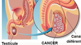 Cancer du testicule: la chimiothérapie aussi efficace que la  radiothérapie