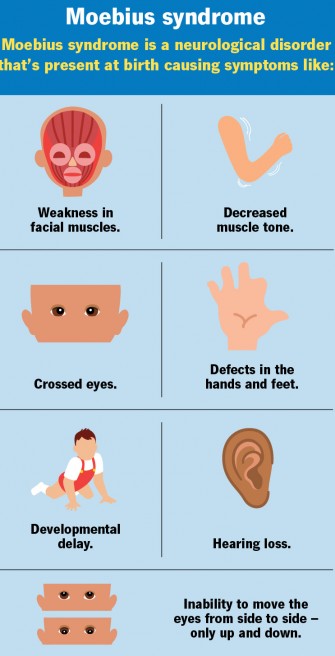 Le syndrome de M&oelig;bius