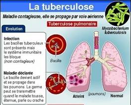 Tuberculose, maladie contagieuse