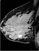 IRM préopératoire dans le cancer du sein : un bilan globalement positif