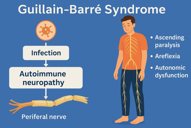 Syndrome De Guillain Barr Conseils Sante dz syndrome-de-guillain-barr-conseils-sante-dz