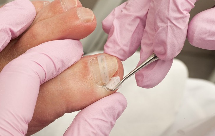 Soigner les ongles incarnés - Conseils - Sante-dz