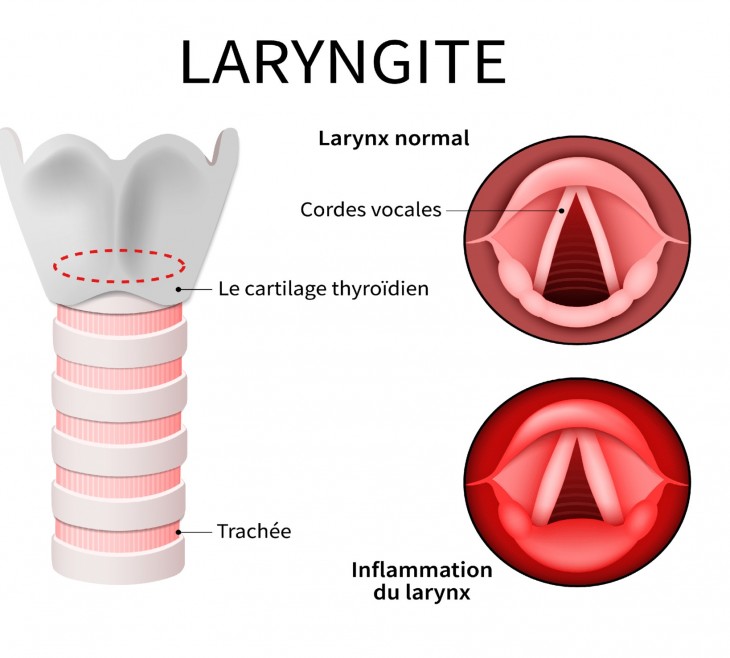 Laryngite - Conseils - Sante-dz