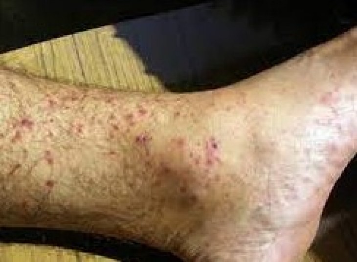 Rickettsioses Actualit s Sante dz rickettsioses-actualit-s-sante-dz