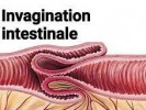 Invagination intestinale