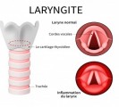Laryngite