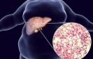 St&eacute;atose h&eacute;patique non alcoolique (NAFLD)