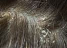 La dermatite séborrhéique de ladulte