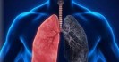 November: mois de sensibilisation aux cancers de poumon
