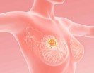 Cancer du sein : pourquoi certains cancers r&eacute;sistent-ils aux traitements ? Les nouvelles pistes de la recherche